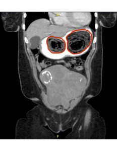 Bezoars: An Interesting Case of Abdominal Pain 2 Creative Commons images