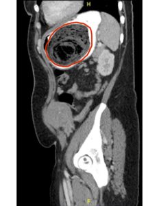 Bezoars: An Interesting Case of Abdominal Pain 3 Creative Commons images