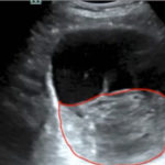 Point-of-care Ultrasound in the Diagnosis and Monitoring of Bladder Hematoma vs. Hemorrhage 1 Creative Commons images