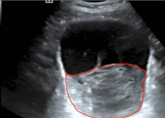 Point-of-care Ultrasound in the Diagnosis and Monitoring of Bladder Hematoma vs. Hemorrhage 2 Creative Commons images