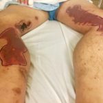 Levamisole Induced, Cocaine Associated Vasculitis 1 Creative Commons images