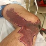 Levamisole Induced, Cocaine Associated Vasculitis 2 Creative Commons images