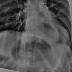 Gastric Volvulus 6 Creative Commons images