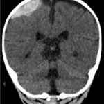Spontaneous Intracranial Hemorrhage in Severe Hemophilia A: A Rare Cause of Seizure in a Young Child 1 Creative Commons images