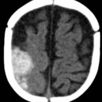 Spontaneous Intracranial Hemorrhage in Severe Hemophilia A: A Rare Cause of Seizure in a Young Child 2 Creative Commons images