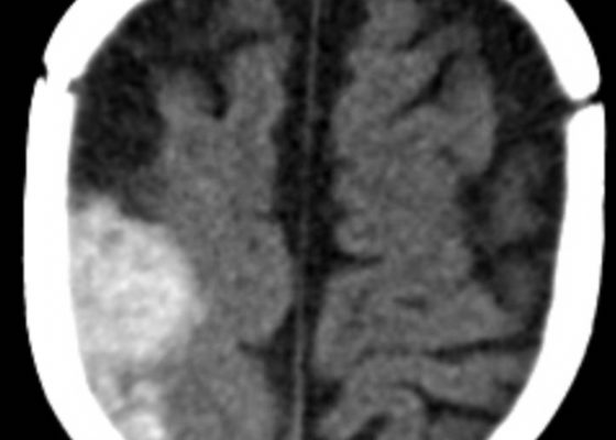 Spontaneous Intracranial Hemorrhage in Severe Hemophilia A: A Rare Cause of Seizure in a Young Child 4 Creative Commons images