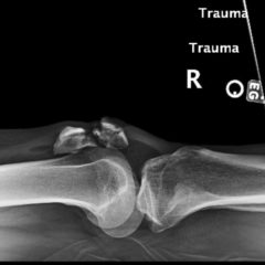 Open Fracture of the Patella 6 Creative Commons images