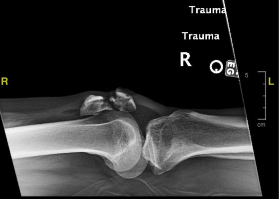 Open Fracture of the Patella 2 Creative Commons images