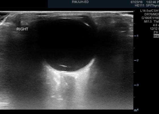 Posterior Vitreous Detachment 16 Creative Commons images