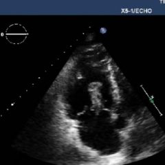 Right Atrial Thrombus 6 Creative Commons images