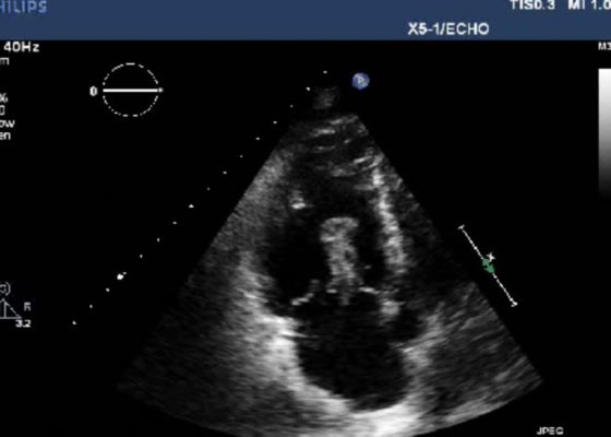 Right Atrial Thrombus 6 Creative Commons images