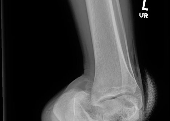 Open Subtalar Dislocation 6 Creative Commons images