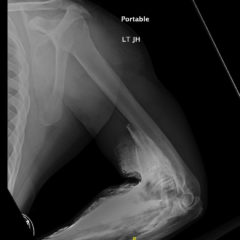 Asymptomatic CT Iodinated Contrast Extravasation of the Upper Extremity 5 Creative Commons images