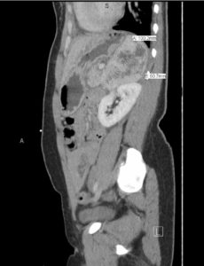 The Elusive Pheo: A Case Report of Pheochromocytoma in the Emergency Department 4 Creative Commons images