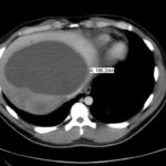 Right Upper Quadrant Pain in a World Explorer 5 Creative Commons images