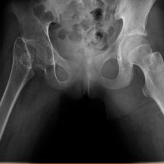Case Report of Untreated Pediatric Femoral Neck Fracture with Osteopenia 7 Creative Commons images