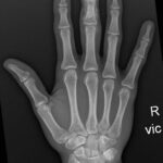 High-Pressure Hand Injection Injury Case Report 1 Creative Commons images