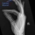 High-Pressure Hand Injection Injury Case Report 4 Creative Commons images