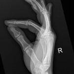 High-Pressure Hand Injection Injury Case Report 3 Creative Commons images