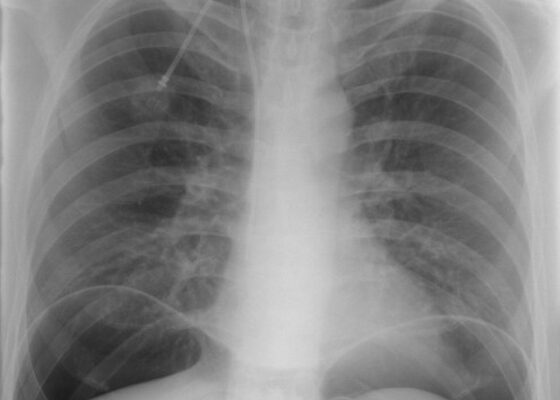 Loose PEG Tube Leading to Peristomal Leakage and Peritonitis 6 Creative Commons images