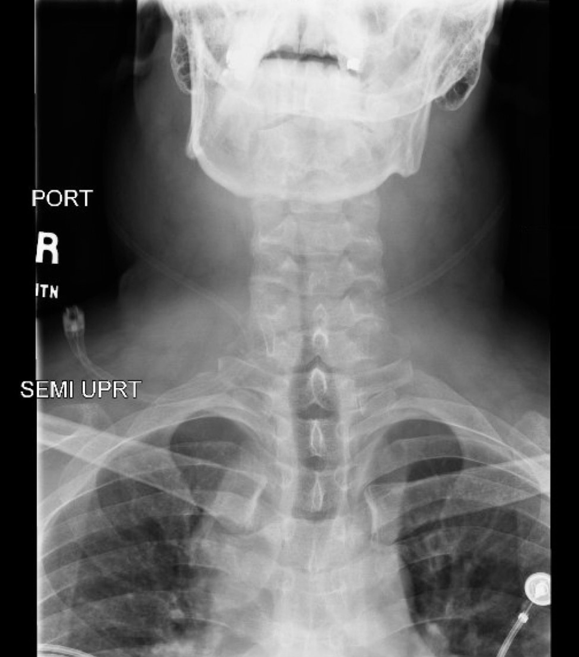 Rapid Airway Narrowing Associated with Hodgkin’s Lymphoma 8 Creative Commons images