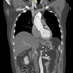Ascending Thoracic Aortic Dissection: A Case Report of Rapid Detection Via Emergency Echocardiography with Suprasternal Notch Views 9 Creative Commons images