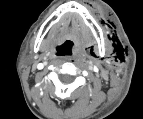 Necrotizing Fasciitis and Mediastinitis after Wisdom Tooth Extraction: A Case Report 10 Creative Commons images
