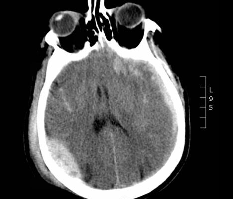 A Case Report of Epidural Hematoma After Traumatic Brain Injury 16 Creative Commons images