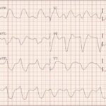 Severe Hyperkalemia 1 Creative Commons images