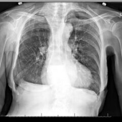 Is an X-ray a Useful Test for Esophageal Food Boluses? A Case Report 5 Creative Commons images