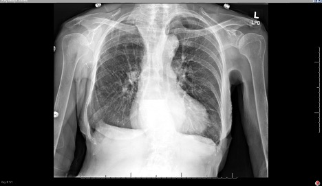 Is an X-ray a Useful Test for Esophageal Food Boluses? A Case Report 4 Creative Commons images