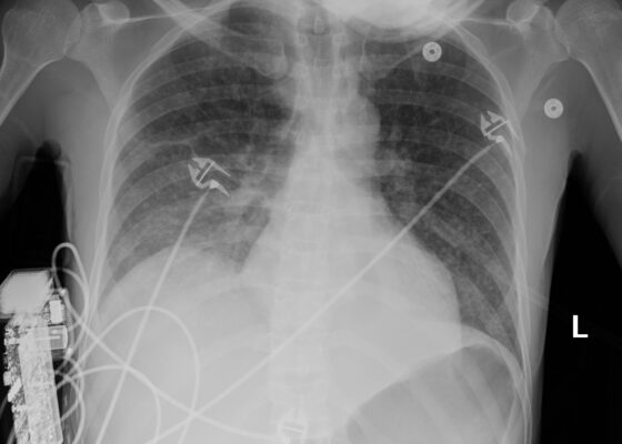 A Case Report on Miliary Tuberculosis in Acute Immune Reconstitution Inflammatory Syndrome 12 Creative Commons images