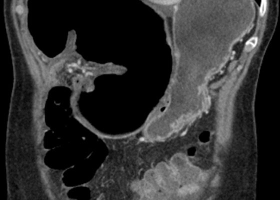 Cecal Volvulus Diagnosed with a Whirl Sign: A Case Report 2 Subtalar Dislocation Jetem