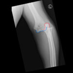 Case Report of Distal Radioulnar Joint and Posterior Elbow Dislocation 2 DRUJ Elbow Xray, AP, Annotated. JETem 2020