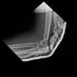 Case Report of Distal Radioulnar Joint and Posterior Elbow Dislocation 3 DRUJ Elbow Xray, Lateral, Post Reduction. Unannotated. JETem 2020