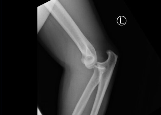DRUJ Elbow Xray, Lateral. Unannotated. JETem 2020