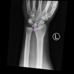 Case Report of Distal Radioulnar Joint and Posterior Elbow Dislocation 8 DRUJ Wrist Xray, AP, Annotated. JETem 2020