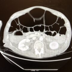 A Case Report of Ogilvie's Syndrome in a 58-year-old Quadriplegic 6 Creative Commons images