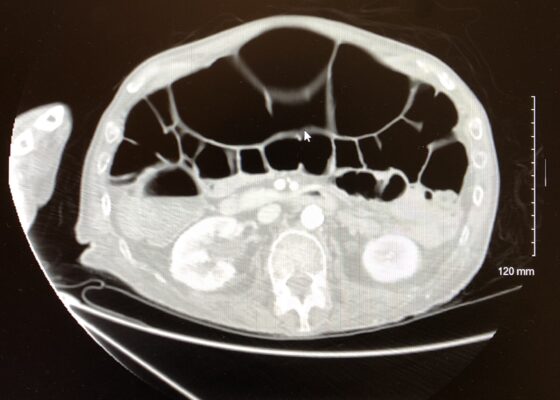 A Case Report of Ogilvie's Syndrome in a 58-year-old Quadriplegic 10 Creative Commons images