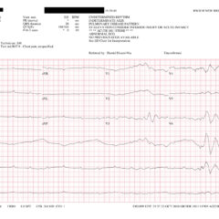 Paroxysmal Ventricular Standstill—A Case Report of all Ps and no QRS in Ventricular Asystole 4 Creative Commons images