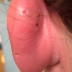 Auricular Perichondritis after a “High Ear Piercing:” A Case Report 1 Creative Commons images
