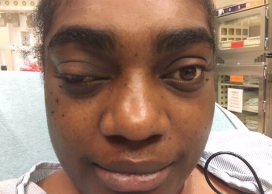 A Case Report of Posterior Communicating Artery Aneurysm Presenting as Cranial Nerve 3 Palsy in a Young Female Patient with Migraines 8 Creative Commons images