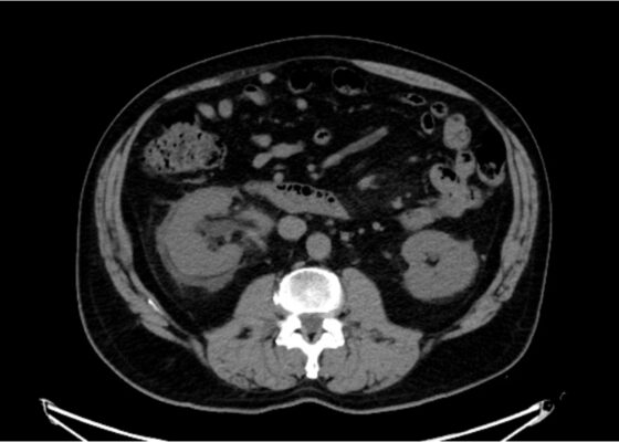 Case Report: Not Your Typical Kidney Stone 12 Creative Commons images