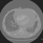 A Case Report of Cardiac Tamponade 4 Creative Commons images