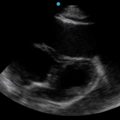 A Case Report of Cardiac Tamponade 5 Creative Commons images