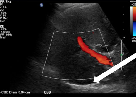 A Case Report on Detecting Porcelain Gallbladder form Wall-Echo-Shadow Sign on Point-of-Care Ultrasound 8 Creative Commons images