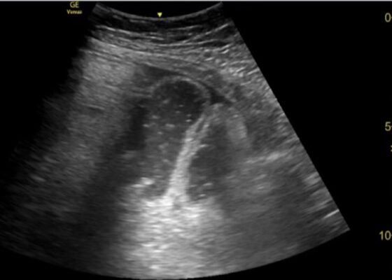 Point of Care Ultrasound as a Diagnostic Tool to Detect Small Bowel Obstruction in the Emergency Department: A Case Report 6 Creative Commons images