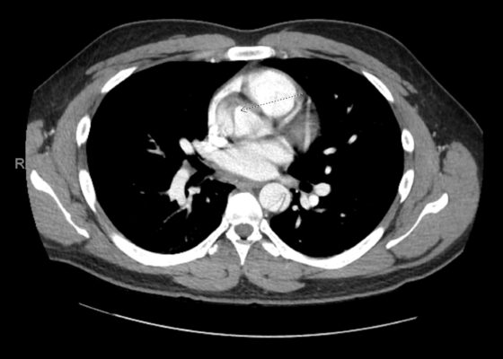 Case Report: Thoracic Aortic Dissection in a Previously Healthy Male with an Unusual Inciting Factor 10 Creative Commons images
