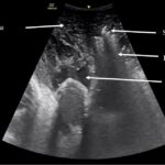 Using Point-of-Care Ultrasound to Expedite Diagnosis of Necrotizing Fasciitis: A Case Report 4 Creative Commons images