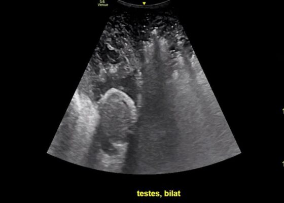 Using Point-of-Care Ultrasound to Expedite Diagnosis of Necrotizing Fasciitis: A Case Report 4 Creative Commons images